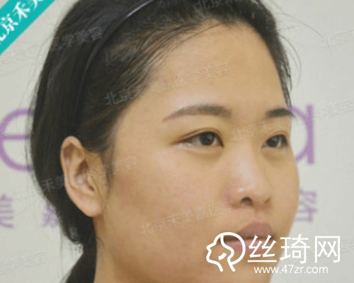 北京禾美嘉醫(yī)療美容自體脂肪填充面部那個醫(yī)生好？