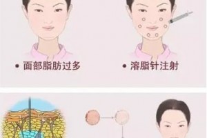 在臉上打溶解脂肪針劑多久會有果