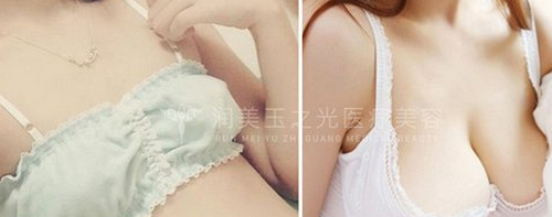 北京潤美玉之光自體脂肪豐胸哪個(gè)醫(yī)生好
