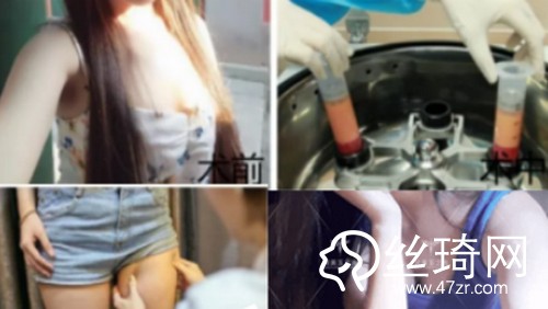 北京潤美玉之光自體脂肪豐胸哪個(gè)醫(yī)生好