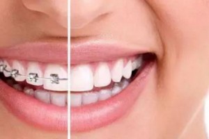 成人做牙齒矯正有危害?牙齒矯正有年齡限制嗎？