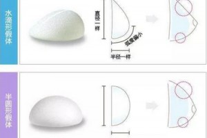 隆胸假體那么多，我們應該如何選擇呢?