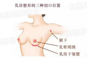 假體隆胸前，我需要做些什么?