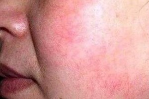 去紅血絲修護方法有哪些呢？