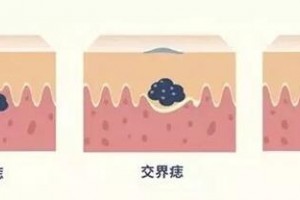 廣州醫(yī)科大學附屬順德醫(yī)院皮膚科主任余南生告訴你什么樣的痣可以選擇激光祛除