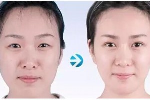 自體脂肪移植豐面部哪些地方，告別面部凹陷