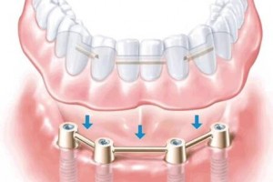 北京京一口腔：種植牙長(zhǎng)壽的秘訣及種植牙護(hù)理方法有哪些
