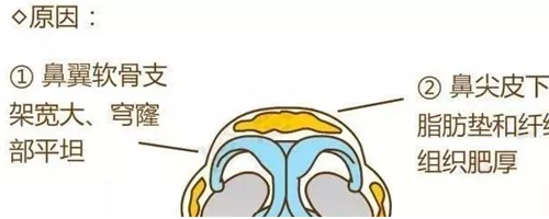 鼻尖肥大原因是什么及微創(chuàng)鼻頭縮小術適合人群是哪些