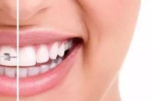 30歲后做牙齒矯正來(lái)得及嗎？做正畸會(huì)有什么危害？