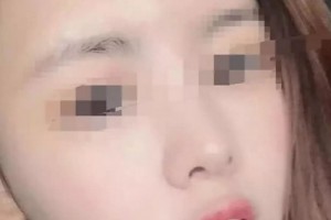 云南瑪麗亞整形美容醫(yī)院做的面部吸脂，原來擁有精致的小臉蛋這么簡(jiǎn)單