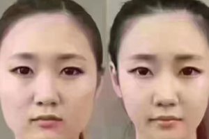 擁有精致小V臉？你只缺一支注射瘦臉注射瘦臉！