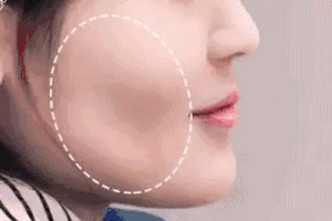 麗都自體脂肪移植，你值得擁有