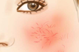 要怎么擺脫紅血絲？臉上有紅血絲的成因時什么