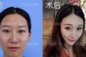 濟(jì)南海峽整形自體脂肪填充：取“脂”于你，用“脂”于你!