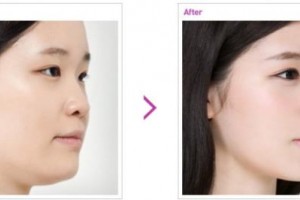 南京韓辰整形美容醫(yī)院價(jià)格表