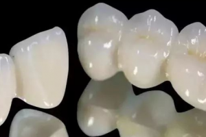 全瓷牙就是烤瓷牙？兩者有差別嗎？該怎么選擇？