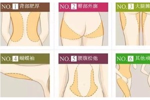 上海天大整形醫(yī)院吸脂果好嗎?上海吸脂減肥要多少錢(qián)？