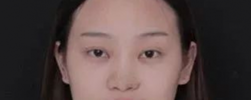 北京鼻部手術價格和鼻部手術術后1-7天的照片