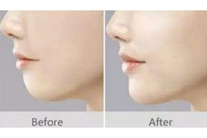 自體脂肪填下巴優(yōu)缺點(diǎn)對(duì)比及術(shù)后注意事項(xiàng)