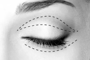 男生割雙眼皮要多少錢 ?
