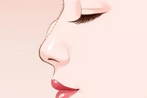 成都駝峰鼻整型價(jià)格多少錢