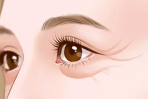 成都眼部注射除皺多少錢