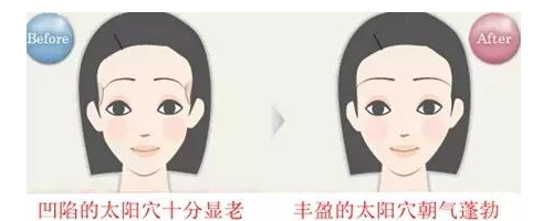 晶馨SG自體脂肪細(xì)胞豐太陽穴，秒變V臉女神不是夢！