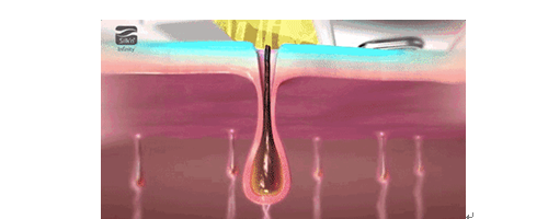 美萊妍學(xué)社做過激光脫毛的你，對它真的了解嗎？