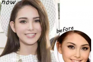 牙齒美白——擁有一口健康亮白的牙齒，笑起來才會更迷人！