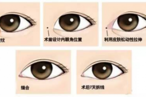 雙眼皮手術(shù)要和開眼角手術(shù)一起做是什么原因