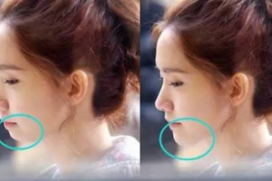 有了下巴，人都美了！面部有輪廓了，氣質(zhì)更好了！