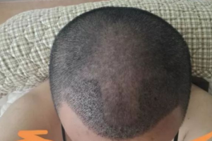 【植發(fā)科普】種植頭發(fā)后出現(xiàn)發(fā)癢癥狀屬于這種情況要警惕毛囊炎