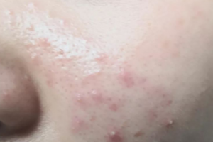 調(diào)節(jié)痘痘為什么不能依靠美容院，化妝品？