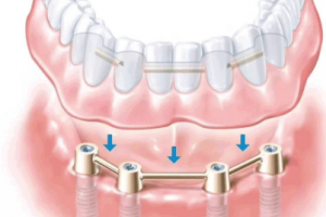 種植牙長(zhǎng)壽的秘訣