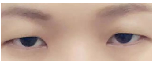 【普賽克】矯正上瞼下垂，get美眼