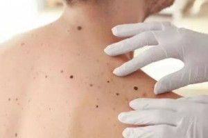 激光激光祛痣，還你肌膚“清白”！