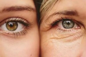 激光去眼袋的優(yōu)點(diǎn)是什么？激光去眼袋有哪些注意事項(xiàng)?