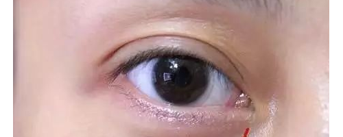 為啥？你做了去眼袋手術(shù)后，又復(fù)發(fā)了呢？