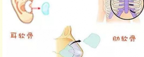 [普及]自體軟骨隆鼻？軟骨來自身體哪個部位呢？