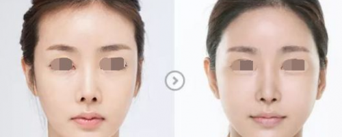 發(fā)際線后退？一招幫你解決！