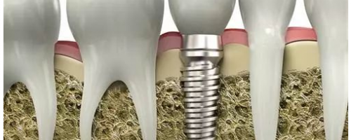 口腔科普：什么是種植牙？
