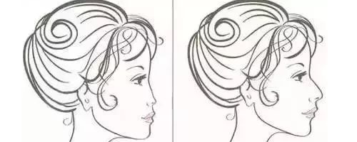 隆鼻N年后會(huì)怎么樣？需要再更換嗎？