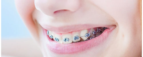 為什么牙齒矯正那么貴？