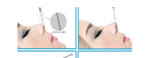 隆鼻要取代假體？感覺有點(diǎn)兒扯