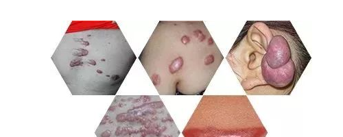 小疙瘩連成疙瘩片，疤痕為什么會越變越大？