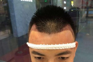 鄭州隴海醫(yī)院毛發(fā)移植中心整形價(jià)格表及醫(yī)院介紹