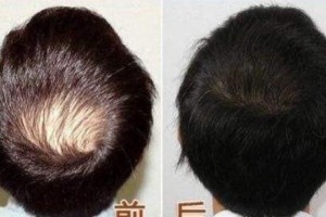 無錫坤如瑪麗醫(yī)院植發(fā)怎么樣附全新價(jià)格表(價(jià)目表)