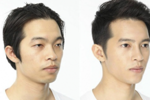 重慶真伊醫(yī)院毛發(fā)種植中心怎么樣附全新價(jià)格表(價(jià)目表)