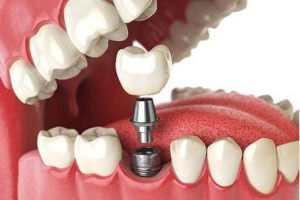 2020濟(jì)南雅寶特口腔醫(yī)院整形價格表(價目表)全新發(fā)布