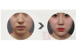 什么是頦部填充術(shù)，如何快速消腫